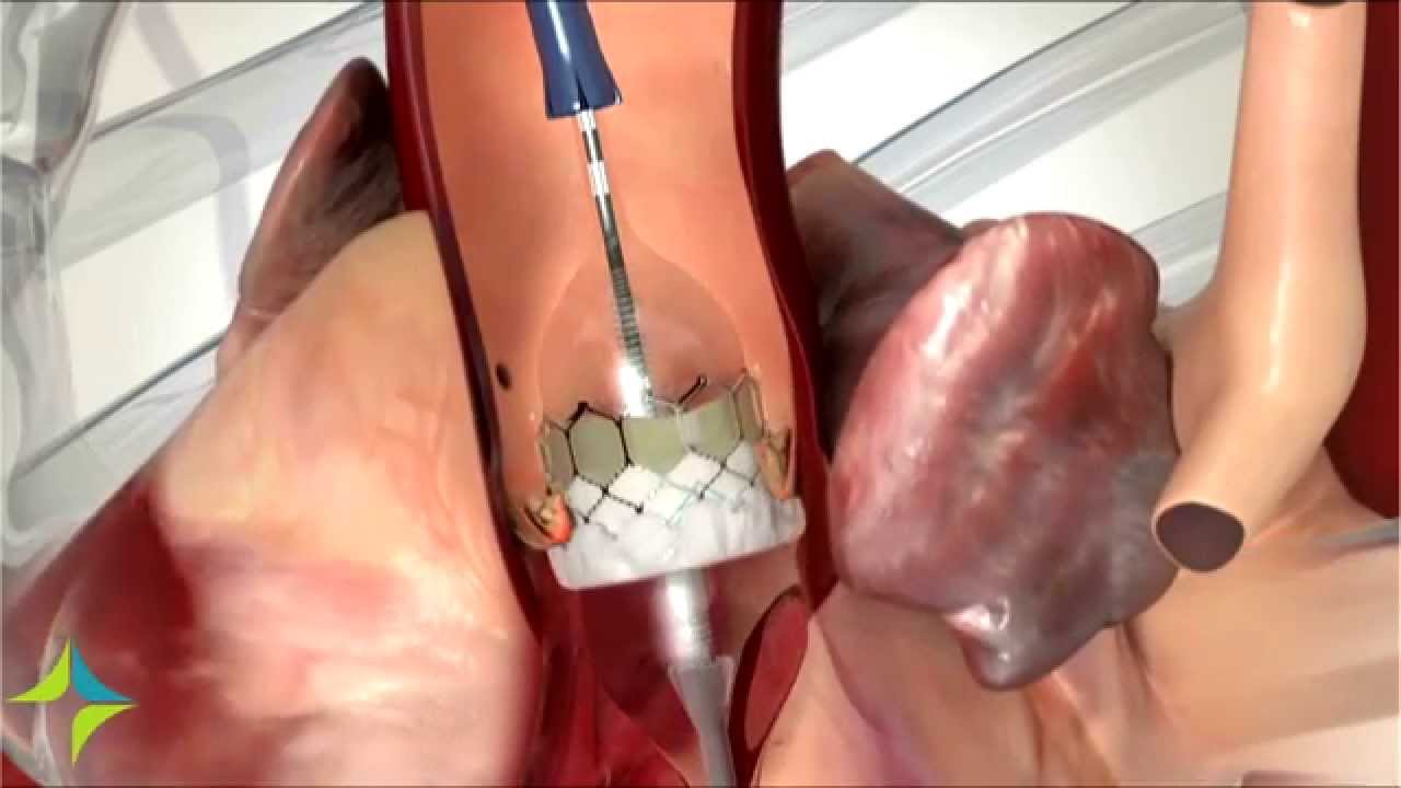 صمام الحياة ( ( Valve of Life ) )