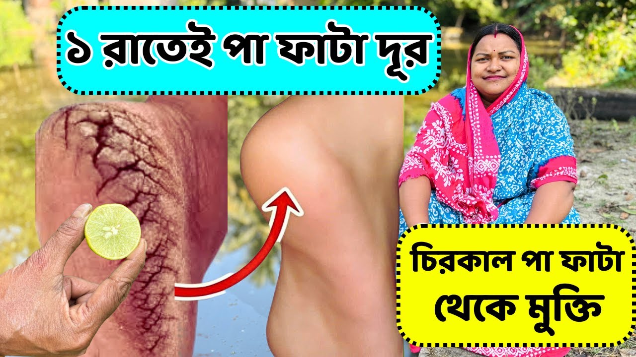 ১ রাতেই পা ফাটা সারানোর টিপস / Cracked heels treatment