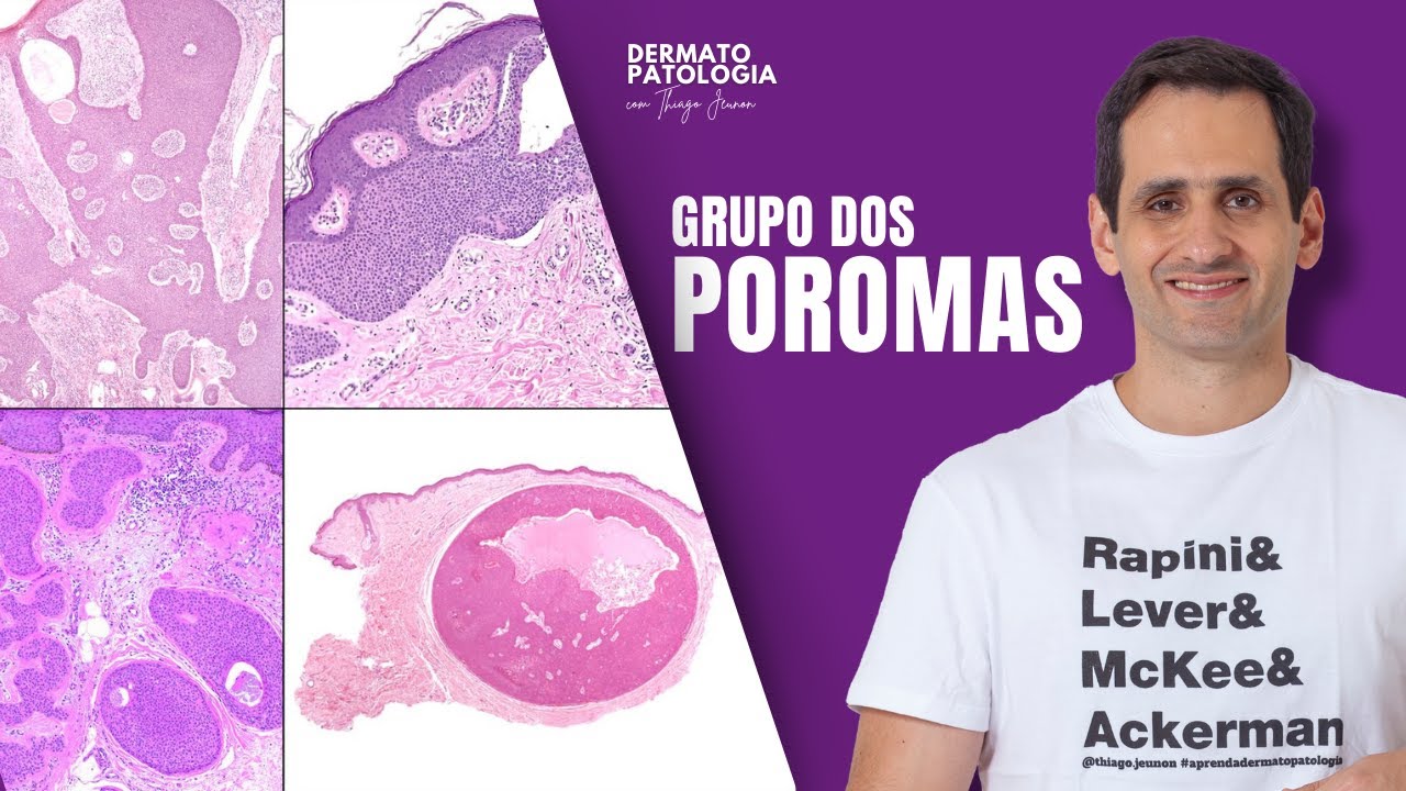 Grupo dos Poromas | Dr. Thiago Jeunon
