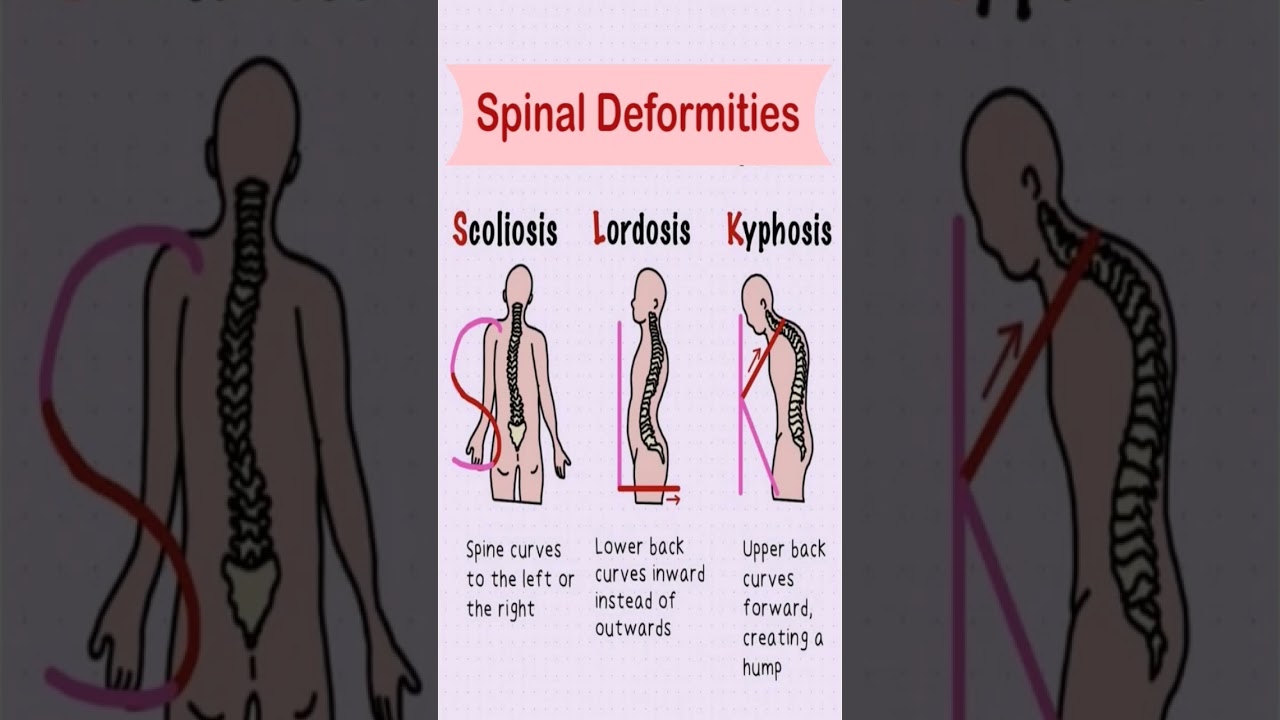 Understanding Spinal Deformities: Scoliosis, Lordosis, and Kyphosis