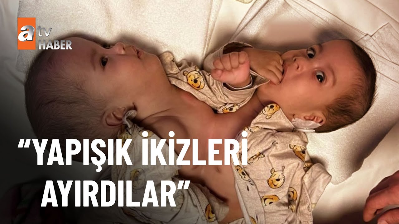 Yapışık ikizleri Türk doktorlar ayırdı! - atv Haber 24 Ekim 2022