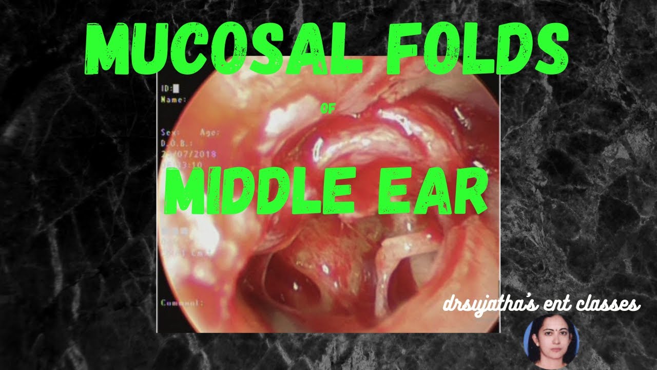 006. Mucosal Folds and spaces  of the Middle Ear  #anatomy of middle ear