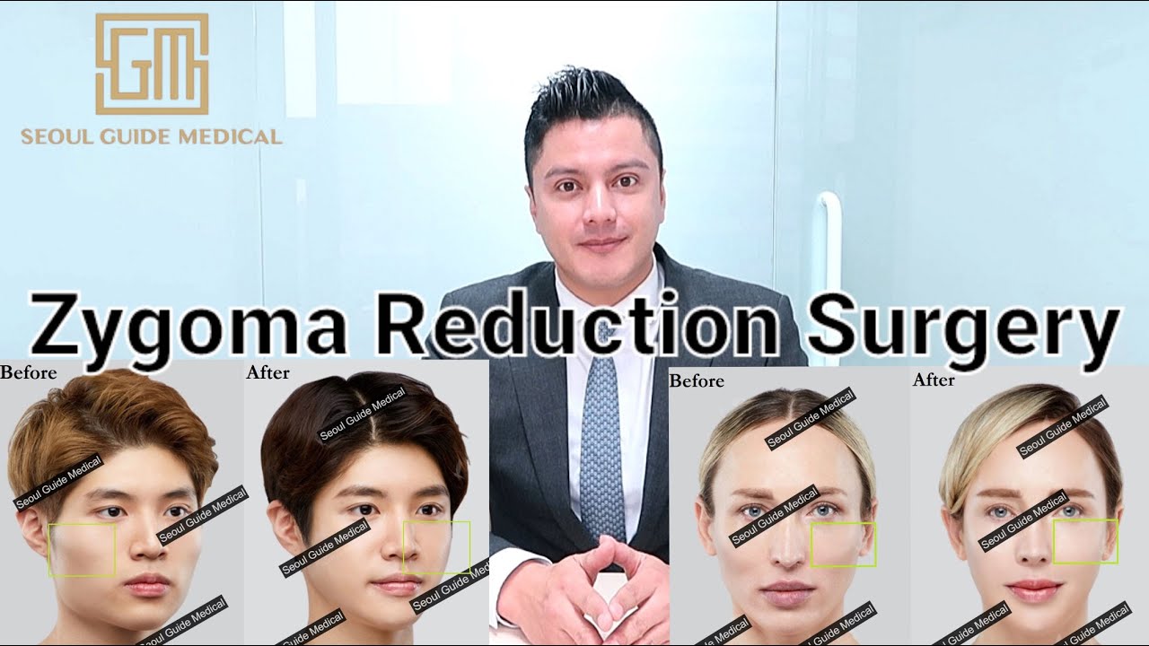 Zygoma/Cheekbone Reduction Explained | Seoul Guide Medical #cheekbonereduction #zygomareduction