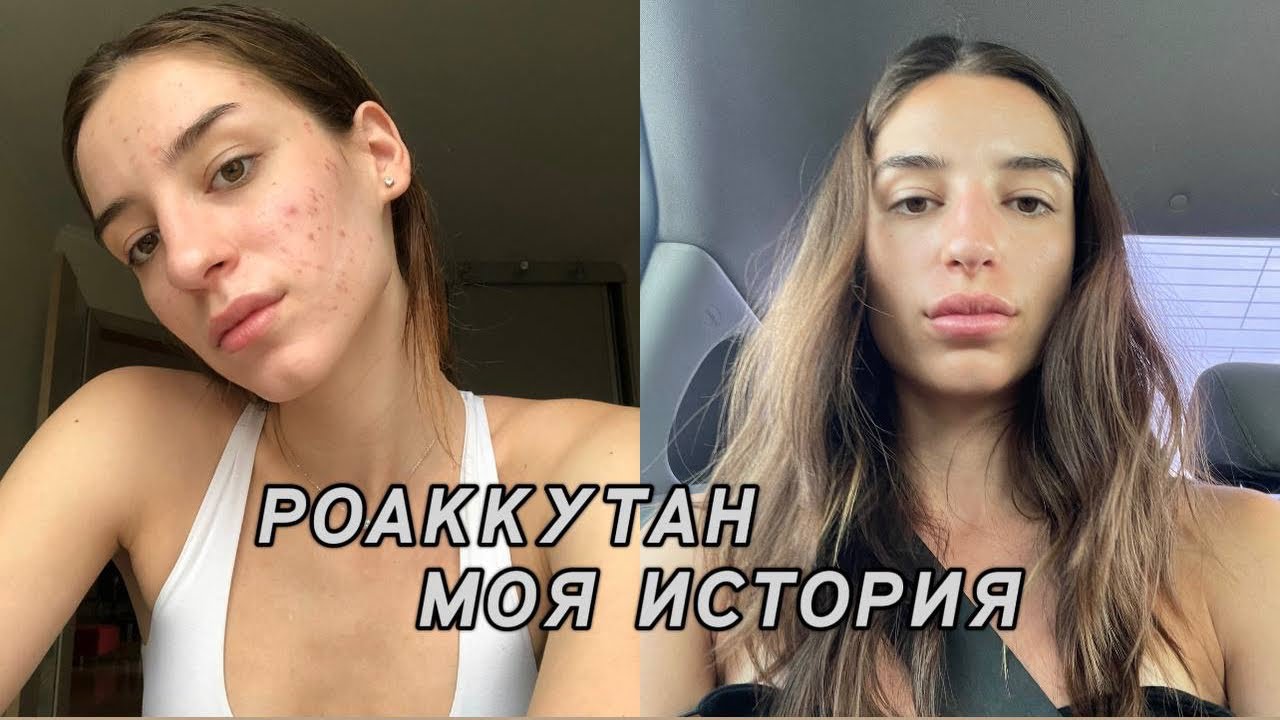 РОАККУТАН МОЯ ИСТОРИЯ! Рецидив, Акнетрент, почему я решилась пить ретиноиды второй раз