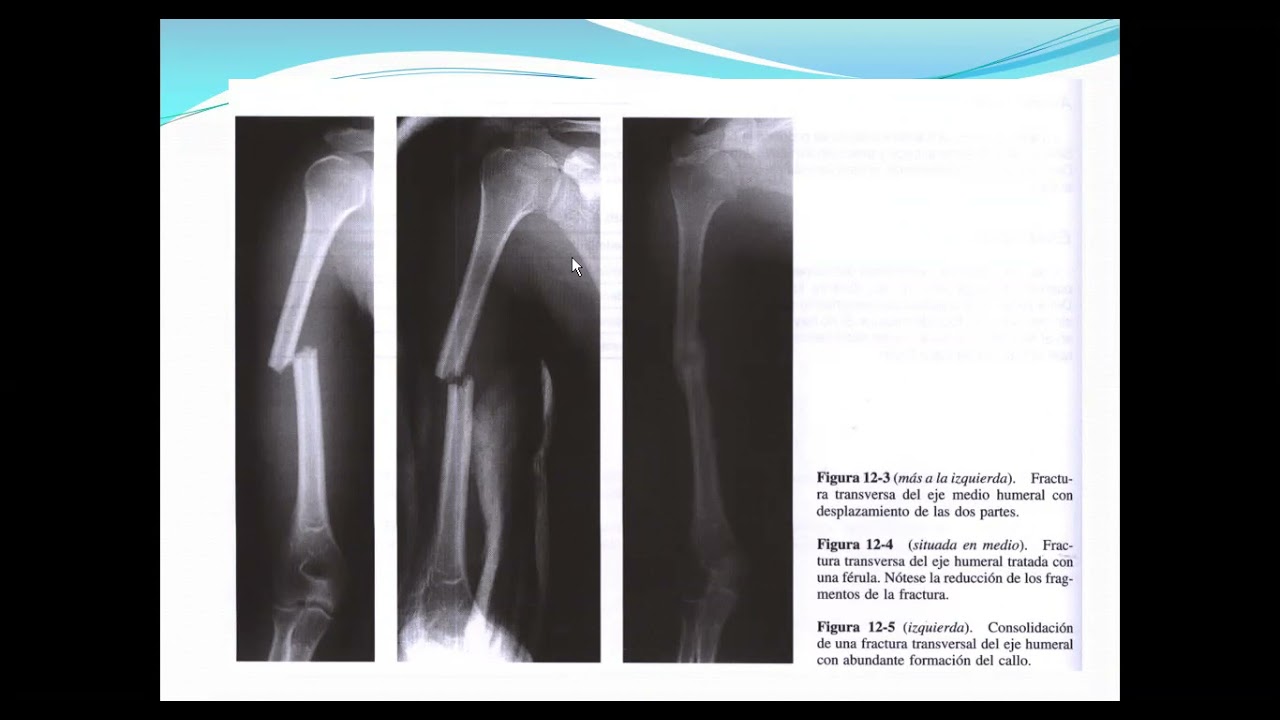 zoom fx de la diafisis de humero