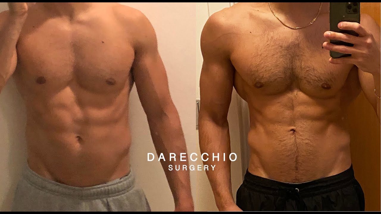 Diastasi Uomo | Dr. Darecchio