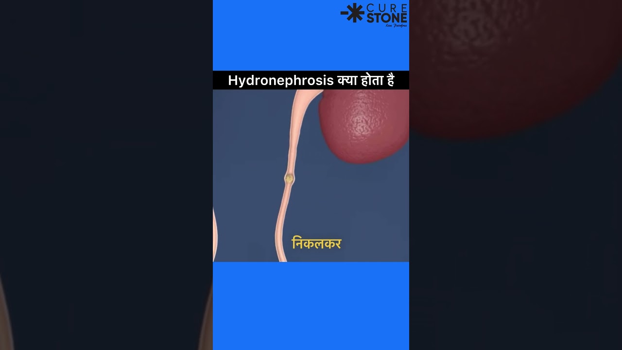 What is hydronephrosis | How kidney swelling happens | rirs |