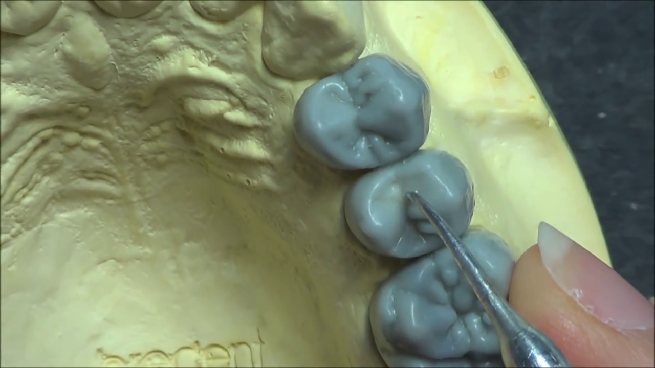 Live wax up-Upper 2nd premolar(occlusion)