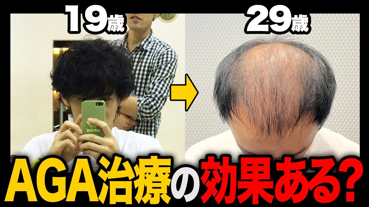 【若ハゲの希望】20代男性が薄毛治療をして6ヶ月でさらなる変化が...。