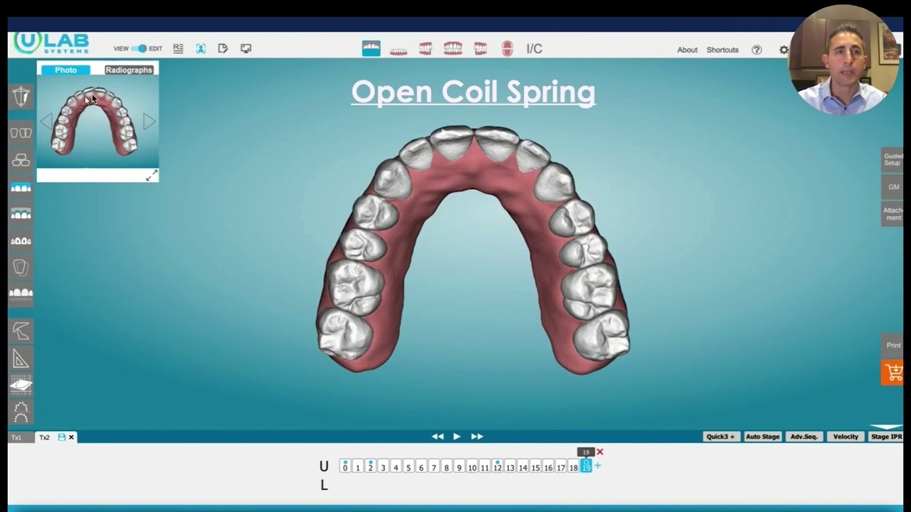 Webinar Clips: Open Coil Spring Technique with Aligners