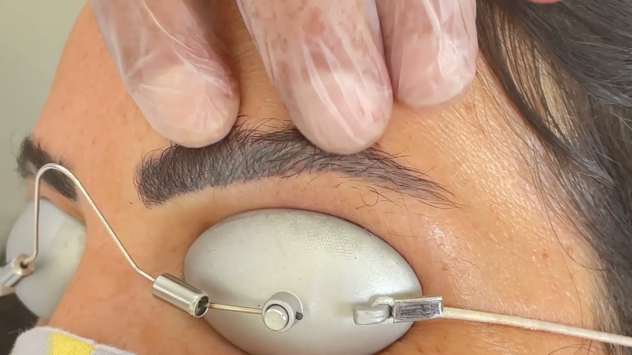 Kaş Silme | Dr. Servet Karayün