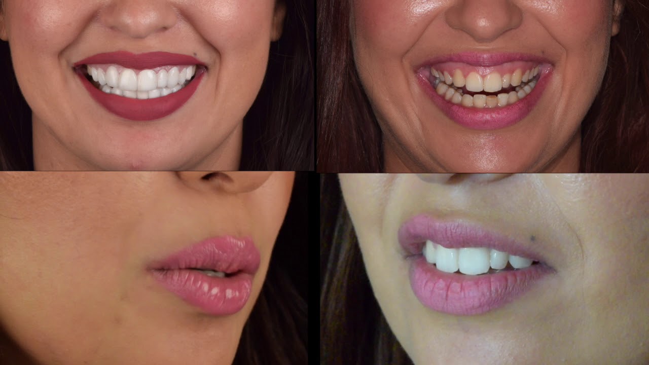Facettes dentaires pour un Hollywood Smile / New Smile Casablanca