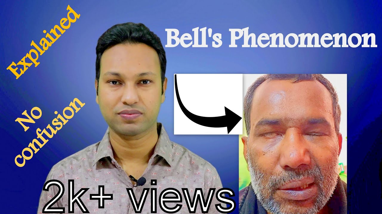 Bell's Phenomenon vs Bell's Palsy: Conception of Upper & Lower Motor Neuron Type Facial Nerve Palsy