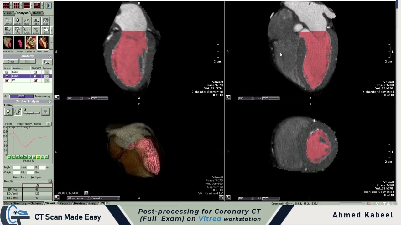 Post-Processing For Coronary CT Full  Exam On Vitrea