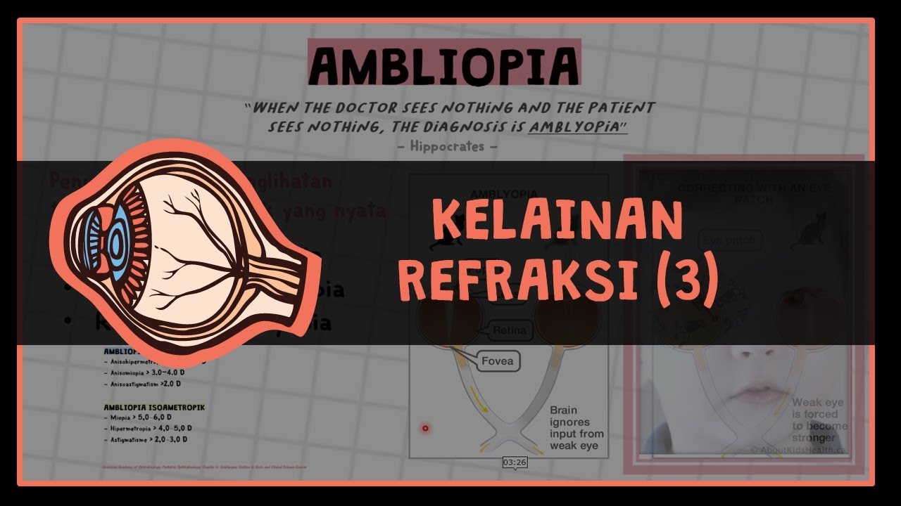 Kelainan Refraksi Part 3 (Anisometropia & Ambliopia) #OPTHALMOLOGY