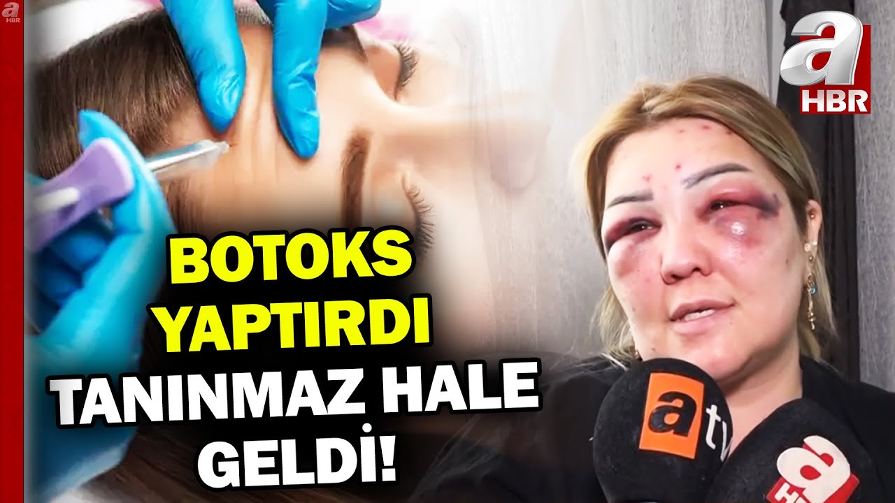 Botoks yaptırmak istedi tanınmaz hale geldi! Uzmanlardan botoks uyarısı... | A Haber
