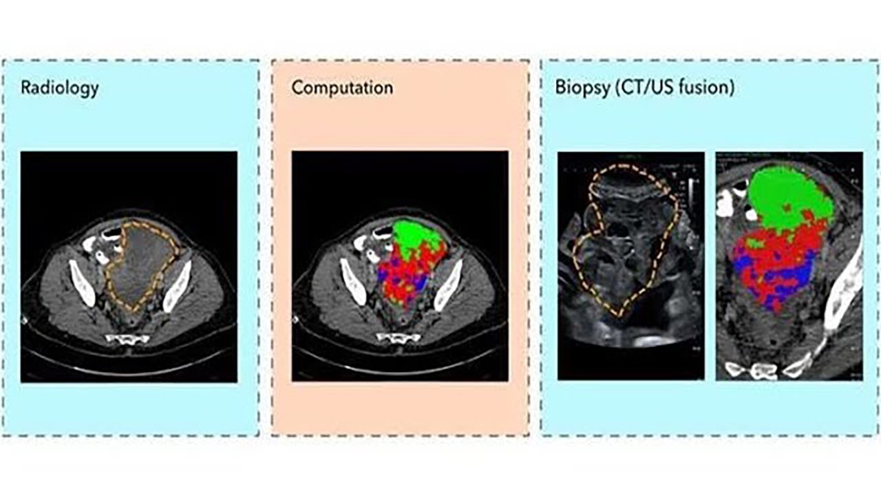 Radiogenomics for virtual biopsy and treatment monitoring in ovarian cancer