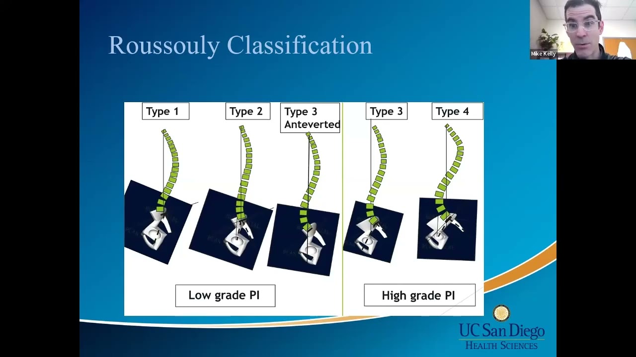 Sagittal Alignment in Spine Surgery presented by Michael Kelly, MD on April 25, 2022