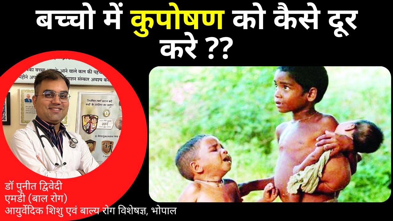 बच्चो में कुपोषण एक बड़ी समस्या : जानिए उसको दूर करने के उपाय | डॉ पुनीत द्विवेदी