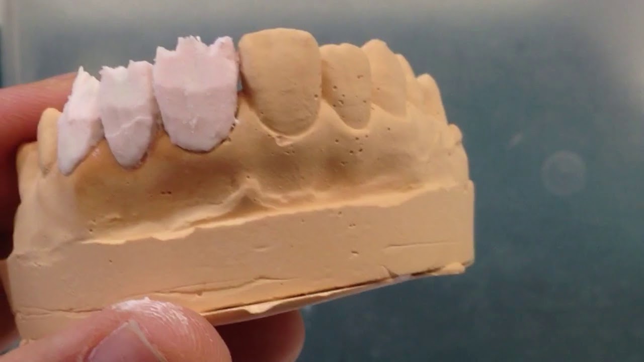 #2-9.1) 3-unit ( canine, lateral,central incisors) labial 다색축성 실제