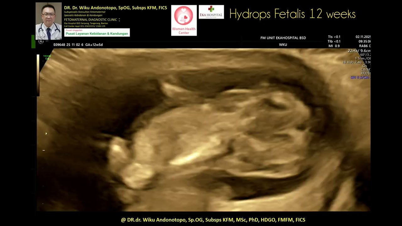 12 weeks Hydrops Fetalis