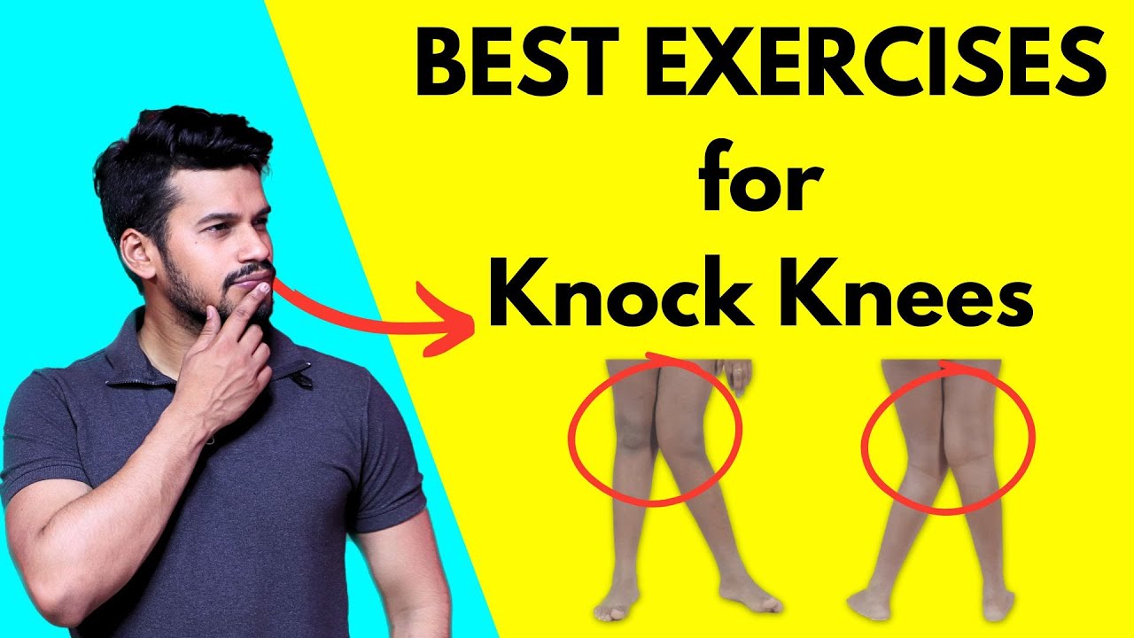 Best Exercises to Correct Knock Knees I  Genu valgum I Leg deformities Samrat Bhardwaj