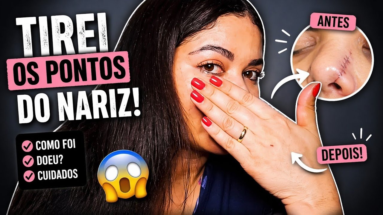 Dia de retirar os pontos do nariz #alectomia #rinomodelacao