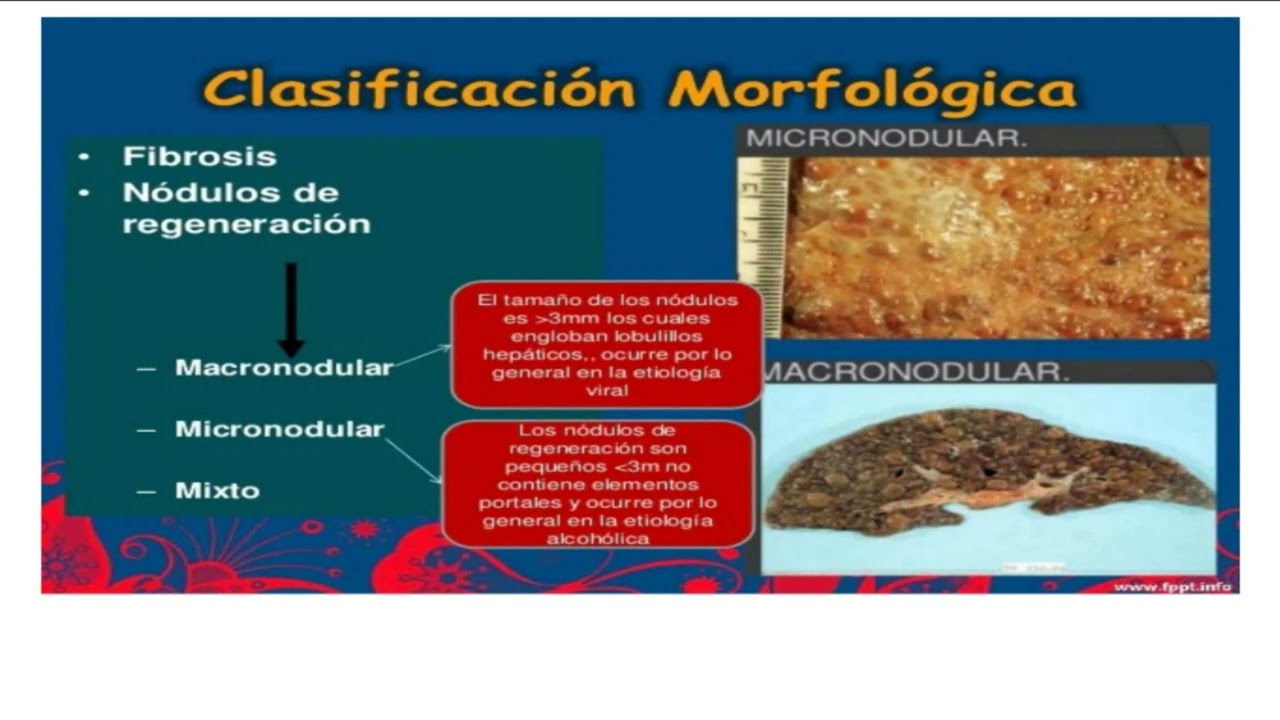 Fisiopatología - Cirrosis Hepática 1/1
