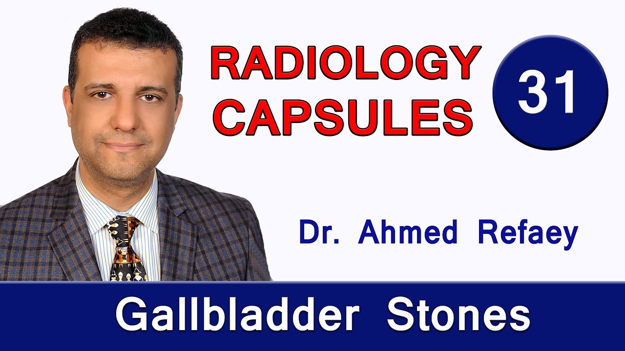 Capsule 31 : Gallbladder Stones