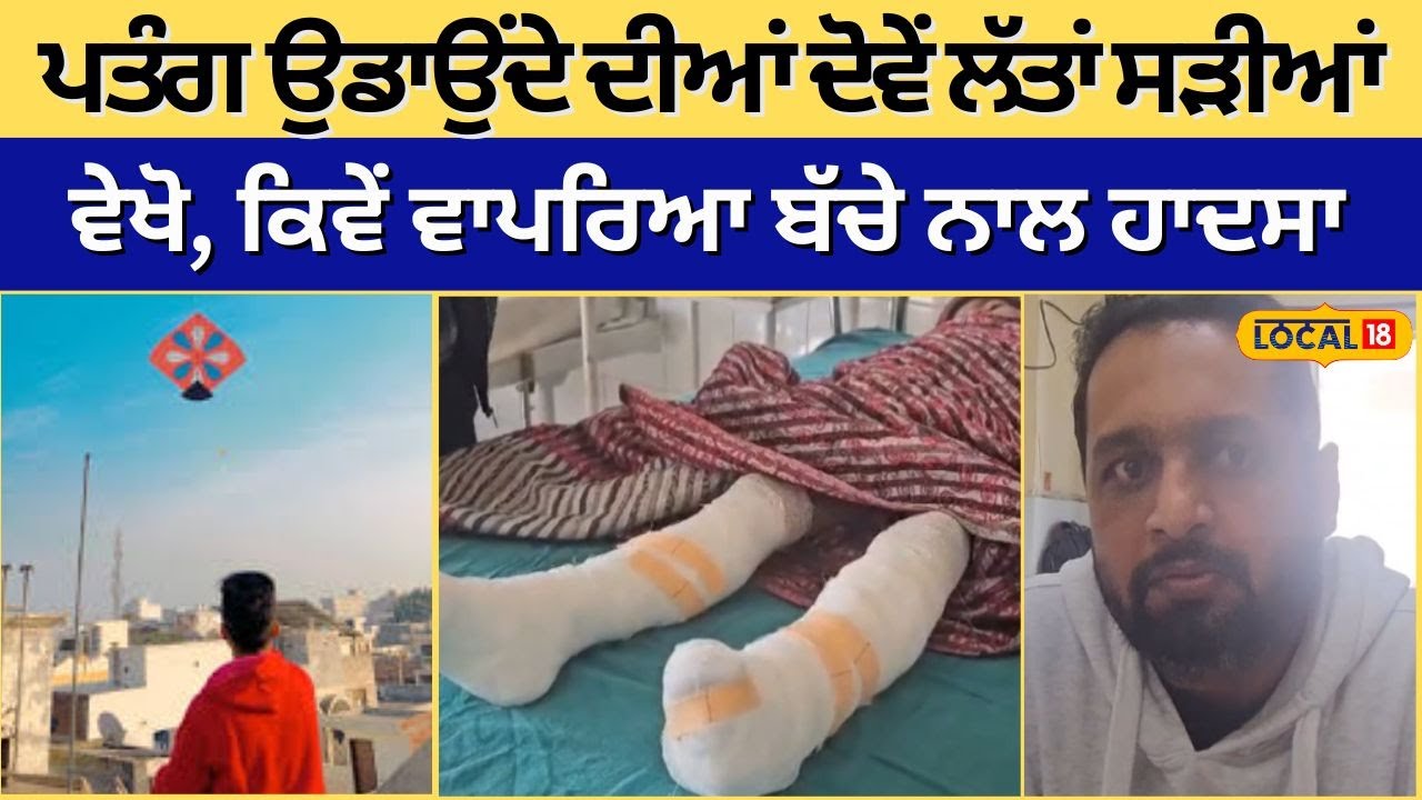 Abohar ’ਚ ਪਤੰਗ ਉਡਾਉਂਦੇ ਹੋਏ ਬੱਚਾ ਡਿੱਗਿਆ ਗਰਮ ਪਾਣੀ ਵਿੱਚ, ਮਾਸੂਮ ਦੀਆਂ ਝੁਲਸ ਗਈਆਂ ਦੋਵੇਂ ਲੱਤਾਂ #local18