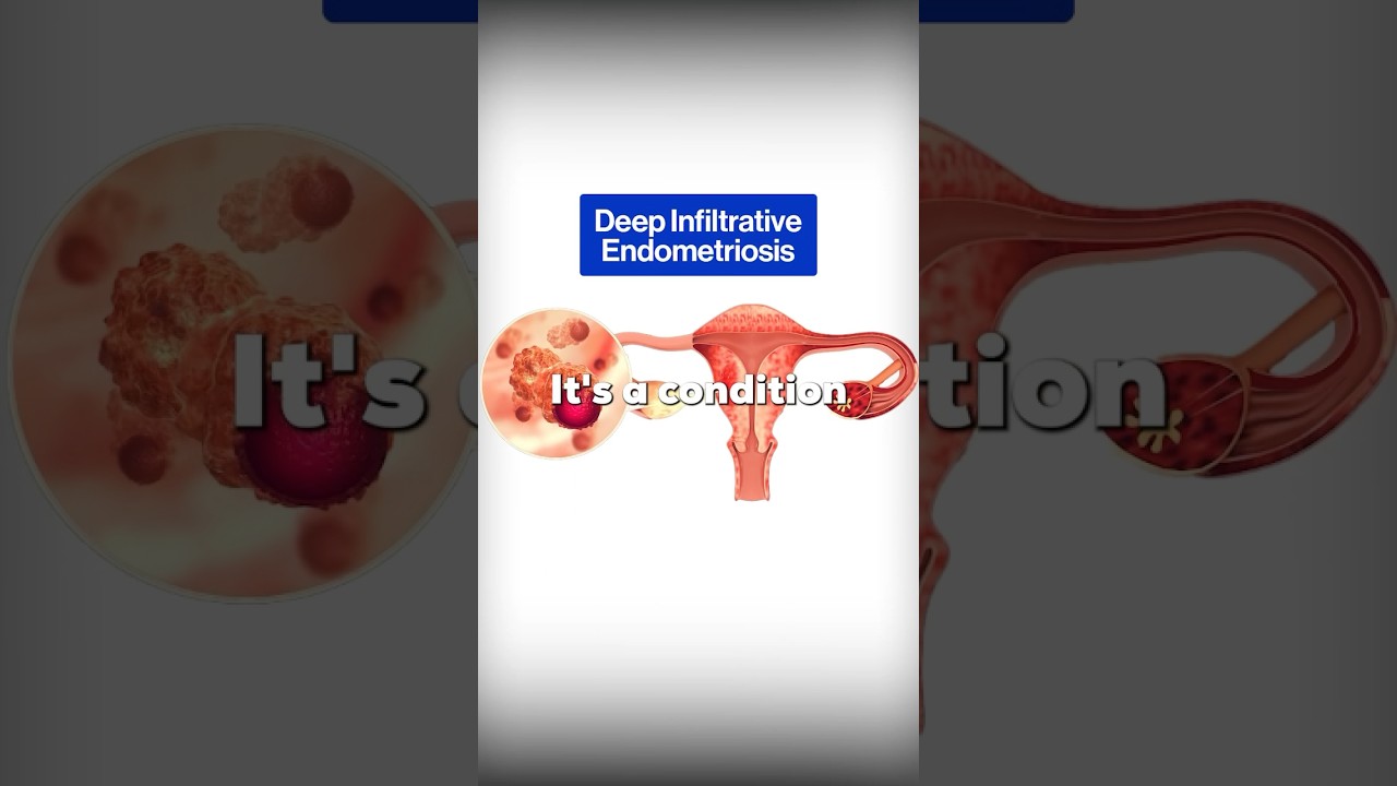 Deep infiltrative endometriosis | Dr mangs | #drmangs #endometriosis #explore #fyp
