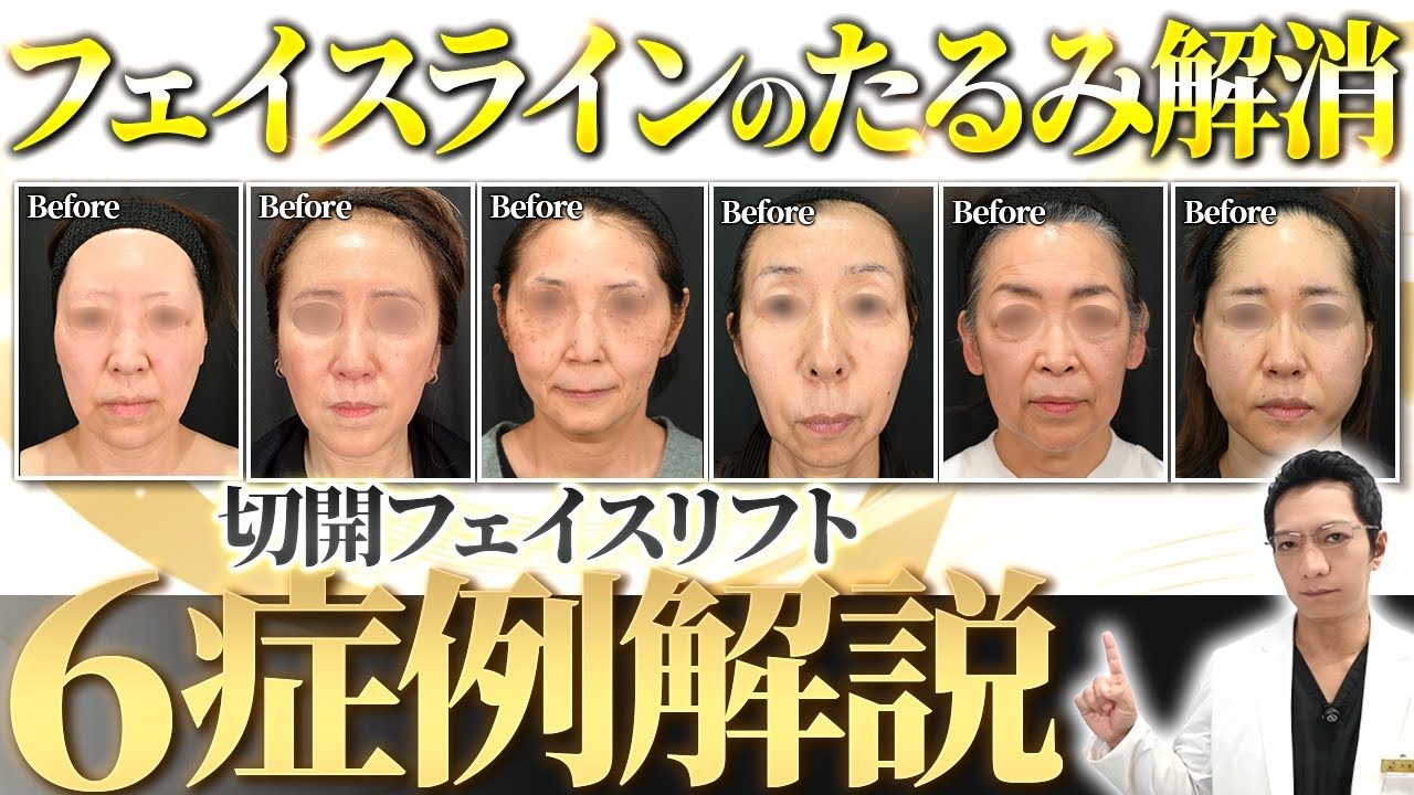 【保存版】フェイスラインのたるみ解消！切開フェイスリフト6症例をたるみ取りのプロが徹底解説！【切開リフト/糸リフト/リフトアップ】