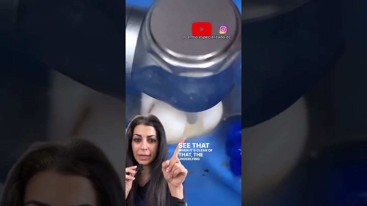 Tooth filling procedure | tooth filling cavity | dental filling procedure | Dr. Yazdan #dentist