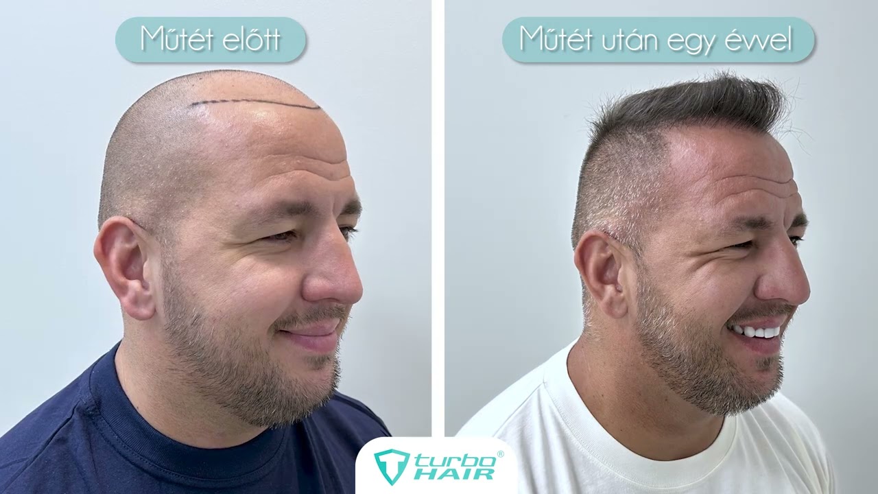 CURTIS HAJBEÜLTETÉSE_EREDMÉNY 1 ÉV UTÁN_HAJBEÜLTETÉS BUDAPESTEN_HAIRTRANSPLANT BUDAPEST_#TURBOHAIR#