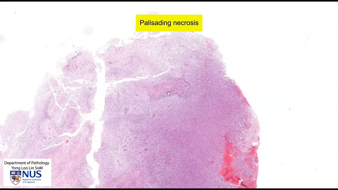 Микроскопия глиобластомы — говорящий слайд