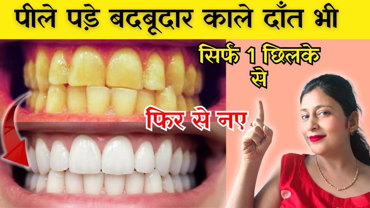 पीले-बदबूदार काले दाँत भी सिर्फ 1 छिलके से बनेंगे बिल्कुल नए | Teeth Whitening at Home