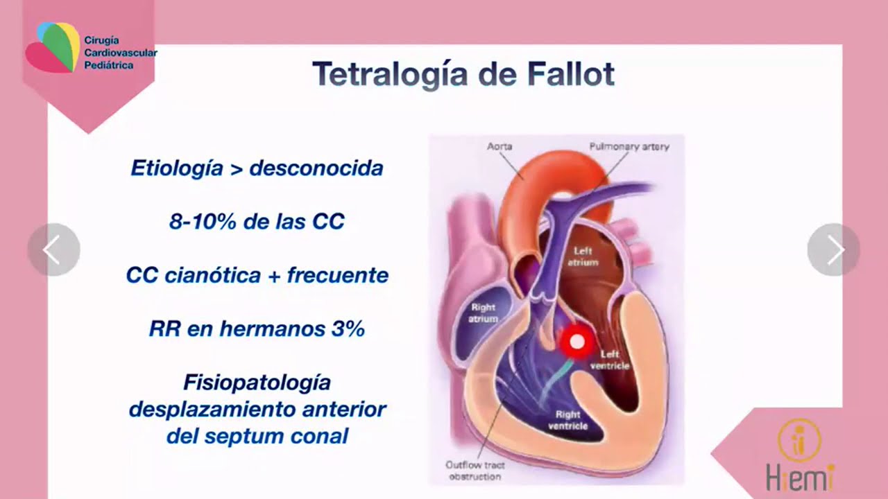 Cuarto seminario. Sección cardiología en Tetralogía de Fallot