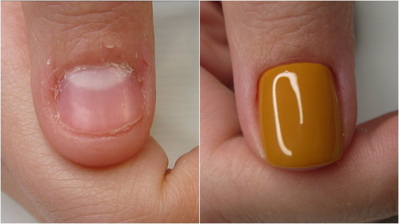 Pantso's Nail-byeting Transformation | Ονυχοφαγία