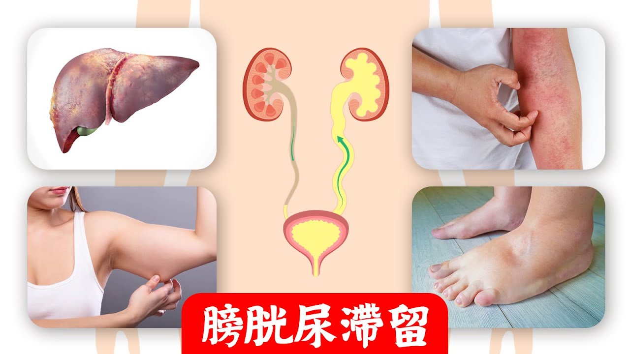 高糖損害腎,膀胱尿滯留8種併發症,自然療法,柏格醫生 Dr Berg