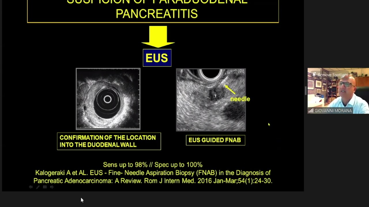 'Mimics of Pancreatic Cancer' delivered by Dr. Gianni Morana Delivered at ICIS 2021