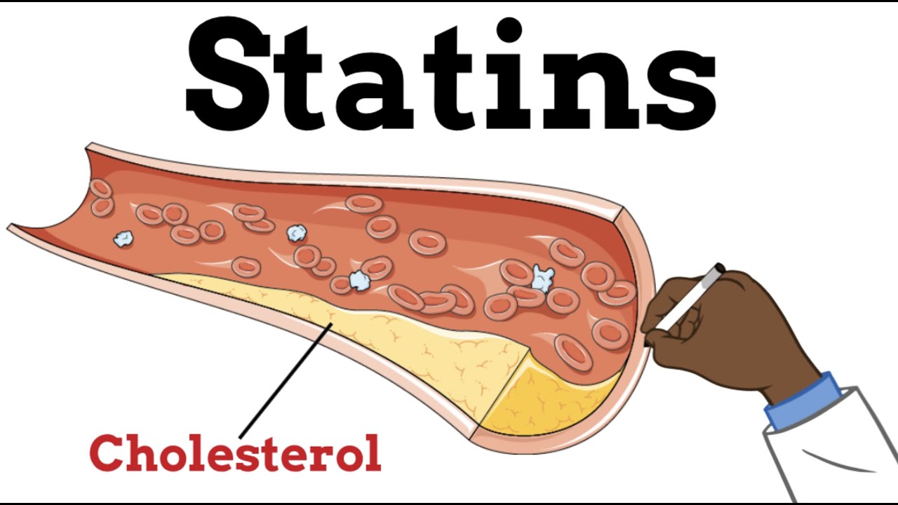 High Cholesterol and Statins