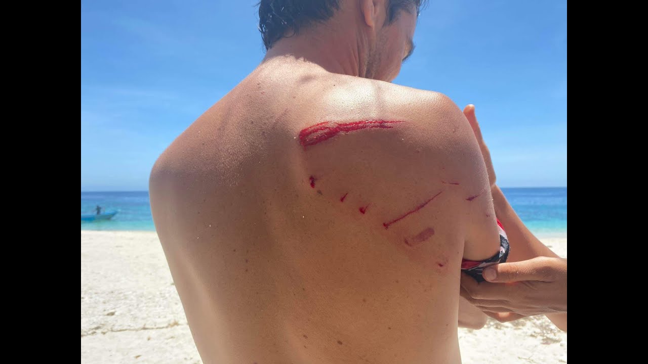 CROCODILE ATTACK SURVIVOR!!