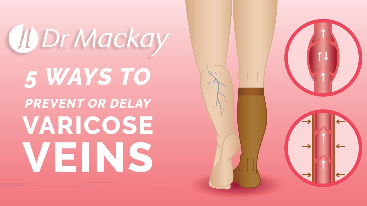How to Prevent Varicose Veins by Dr. Edward Mackay