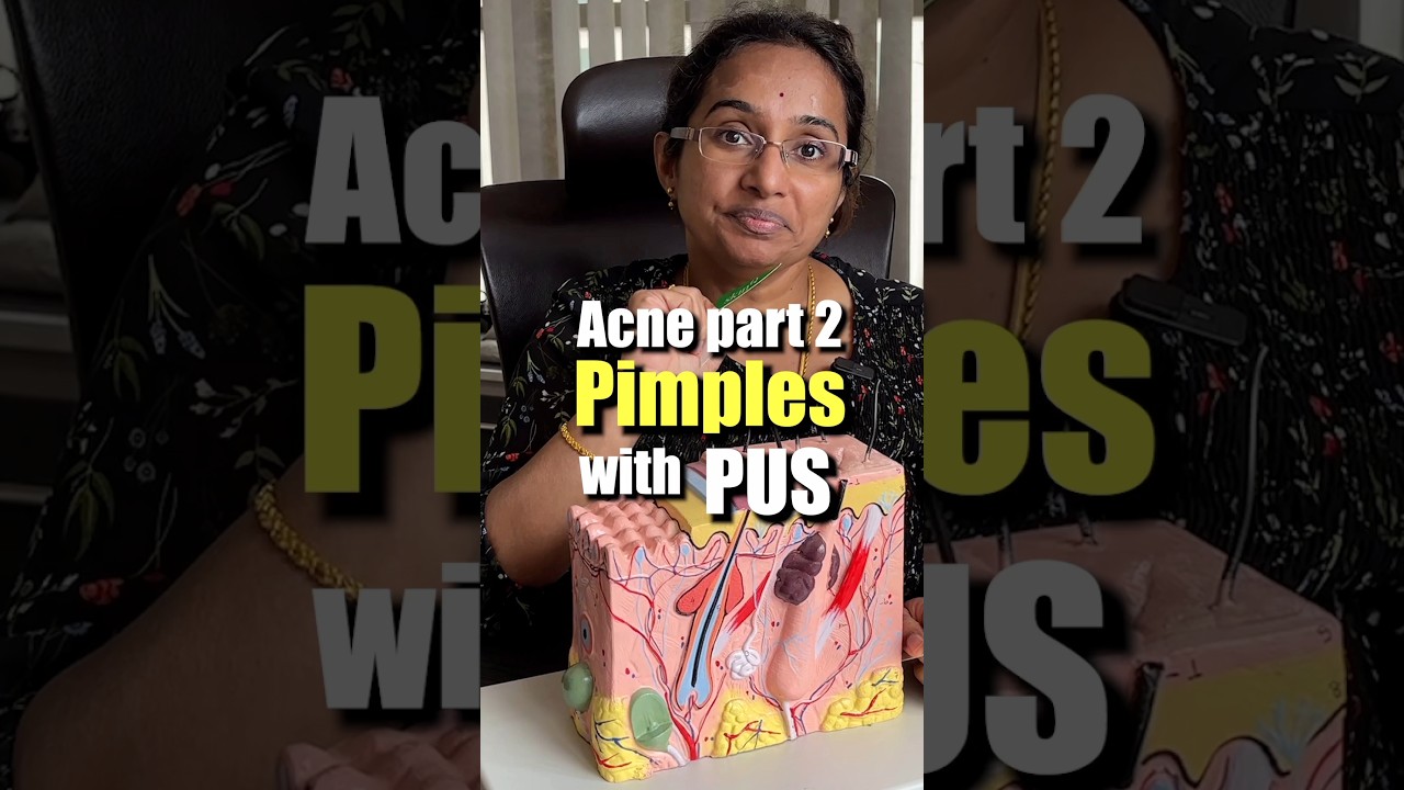 How To Treat Pus Filled Acne At Home | Papules & Pustules #trending