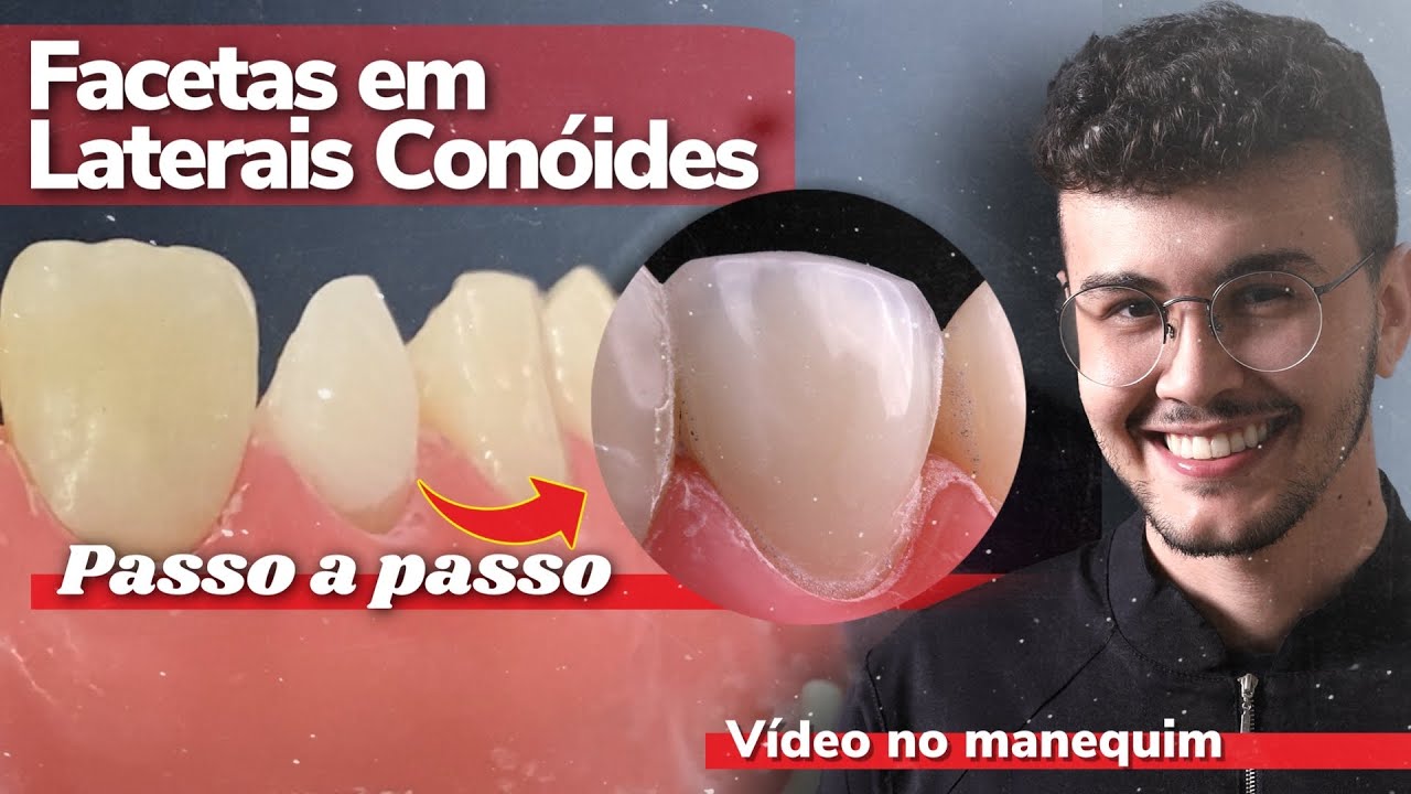 Laterais Conóides - Facetas em Resina [TUTORIAL] Lucas Venâncio