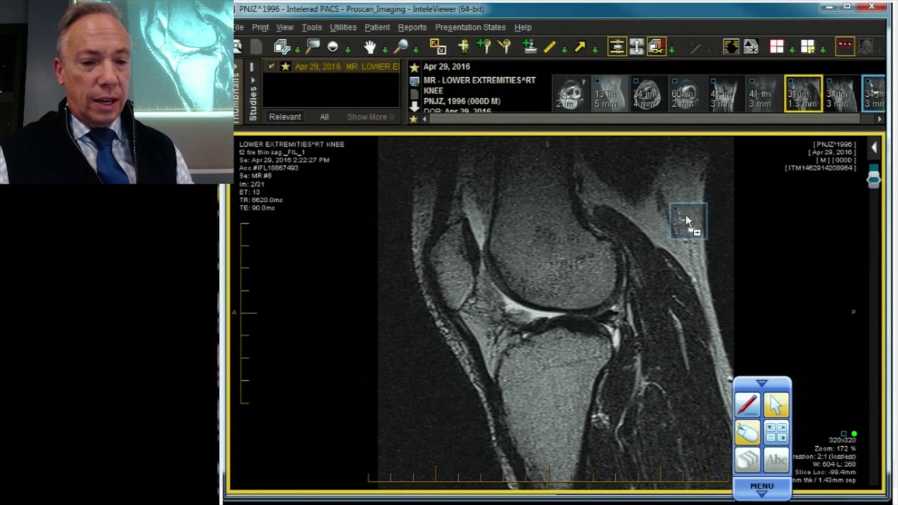 MRI Case Review: Bucket Handle Tear