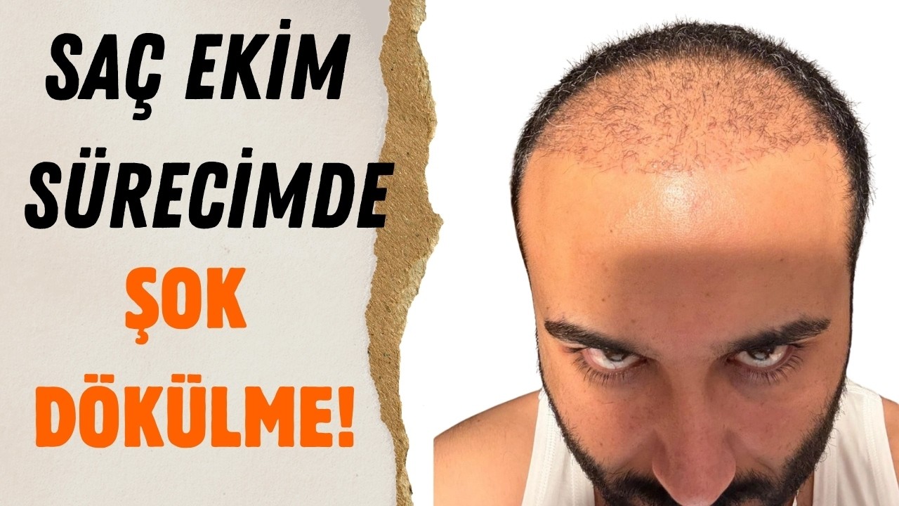 Saç Ekimi Şok Dökülme Süreci: Ne Zaman Başlar? Ne Zaman Biter? #şokdökülme #saçekimisonrası