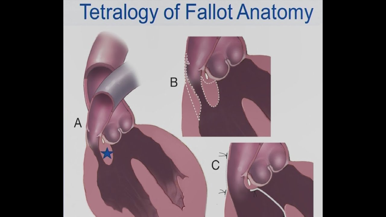 Mayo Clinic – Tetralogy of Fallot