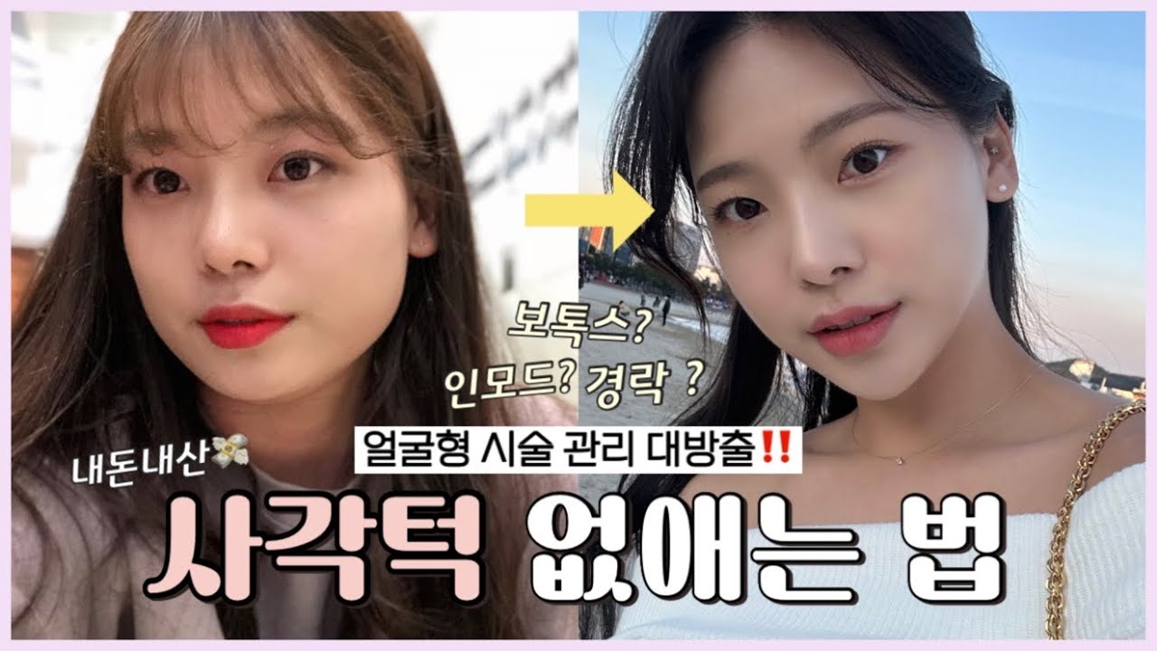 내돈내산💸이중턱•사각턱 없애는법 대방출‼️(얼굴형 시술 추천, 인모드 fx 후기, 스킨 보톡스 후기)