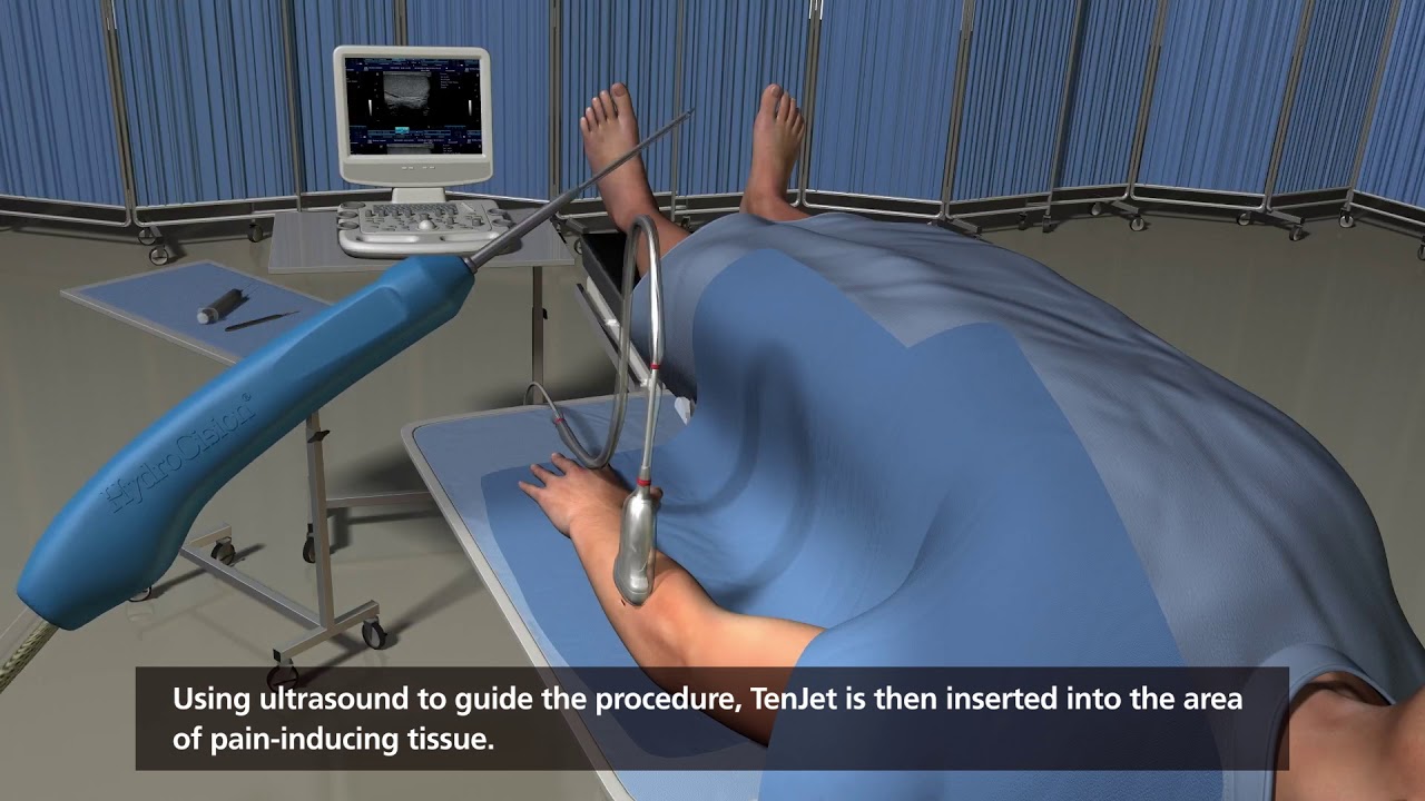 TenJet Patient Animation